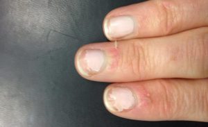 Рани навколо ваших нігтів дозволяють мікробам проникати в організм і слина додає ще один фактор ризику, що іноді призводить до інфекції